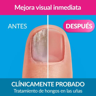 Excilor Forte Anti-hongos Uñas Nude 30ml | Tratamiento Eficaz